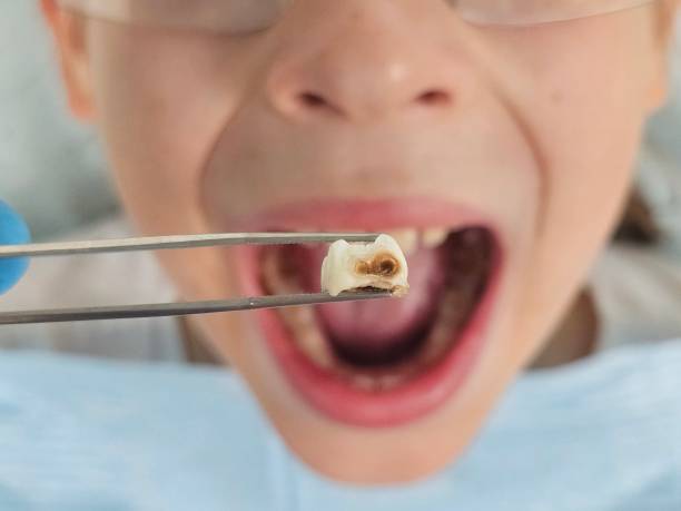 Best Urgent Tooth Repair  in Stony Point, NC